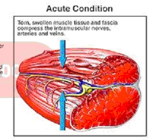 acute muscle-severe pain