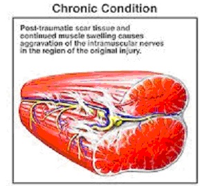 chronic
                              mucsle-painful