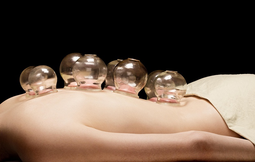 cupping