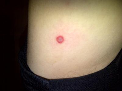 tick bites can be harmful and
                              painful